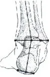 Skate Blade Alignment